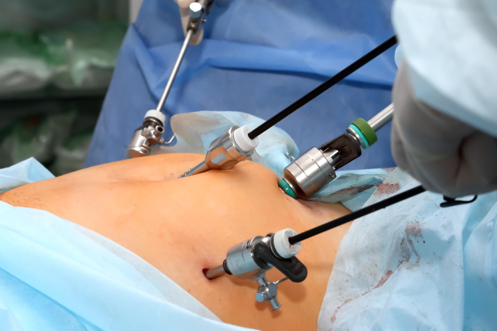 laparoscopy